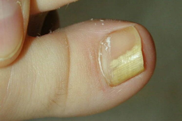 أعراض الفطريات على إصبع القدم الكبير الصورة 1