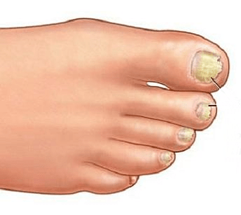 onychomycosis
