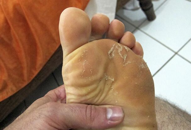 الفطريات على جلد الساقين