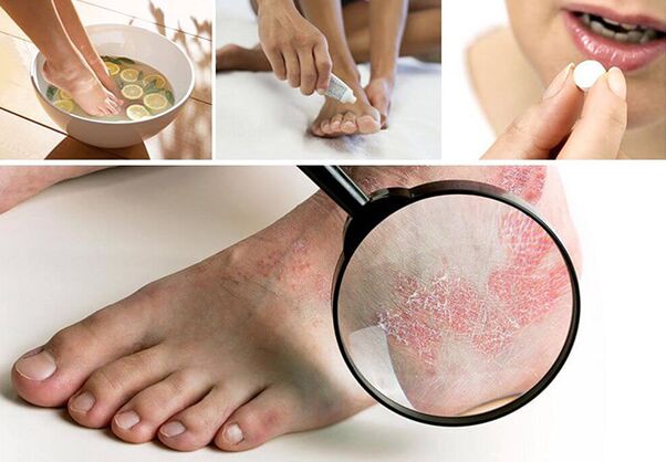 شكل dyshidrotic من الفطريات