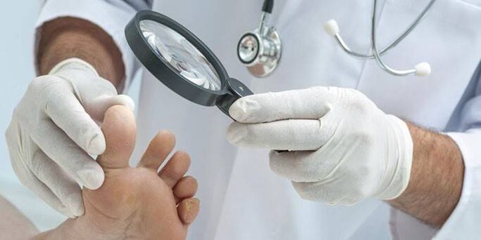 كيفية علاج الفطريات